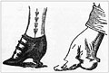 Tight shoes as shown in Jefferis and
Nichols household guide, p. 291.